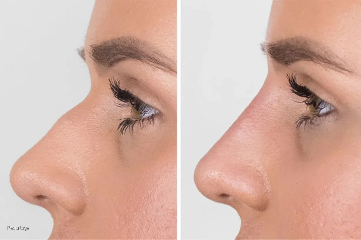 مزایا و معایب فیلر بینی